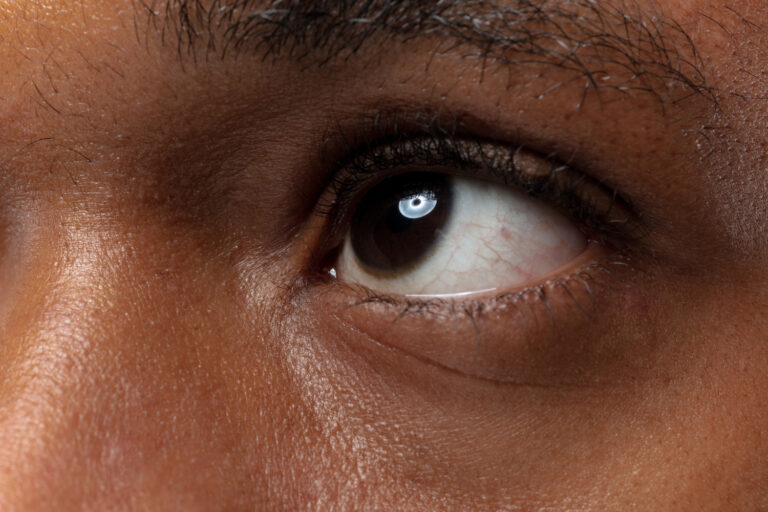 Keratoconus: Understanding the Condition and its Impact on Vision